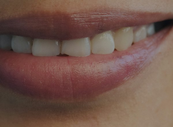 Even, bright smile after composite bonding